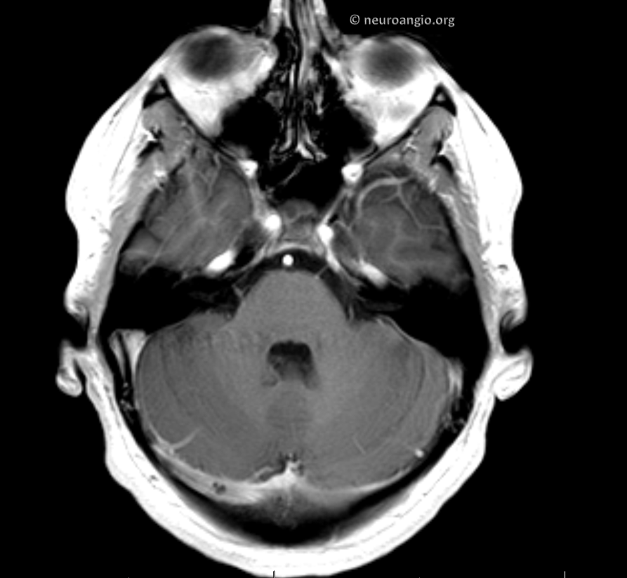 pulsatile-tinnitus-venous-sinus-stenosis-neuroangio